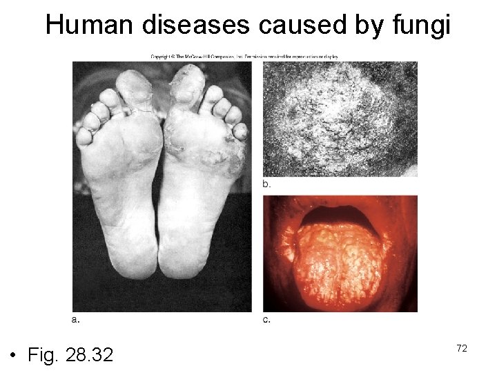 Human diseases caused by fungi • Fig. 28. 32 72 