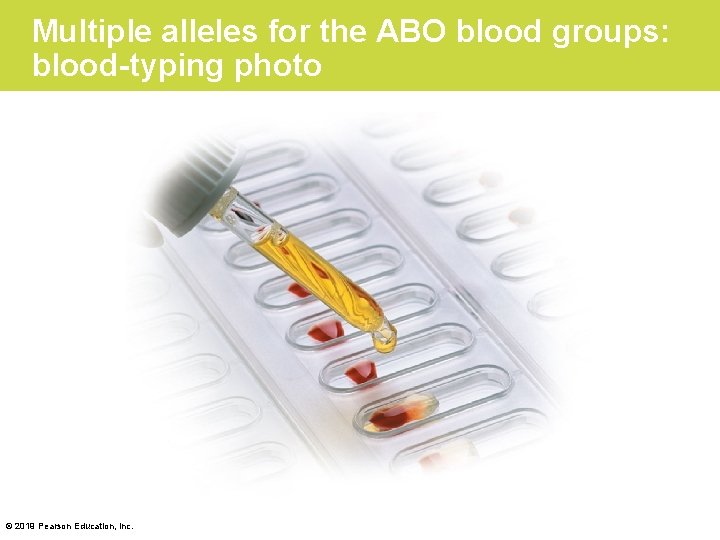 Multiple alleles for the ABO blood groups: blood-typing photo © 2019 Pearson Education, Inc.