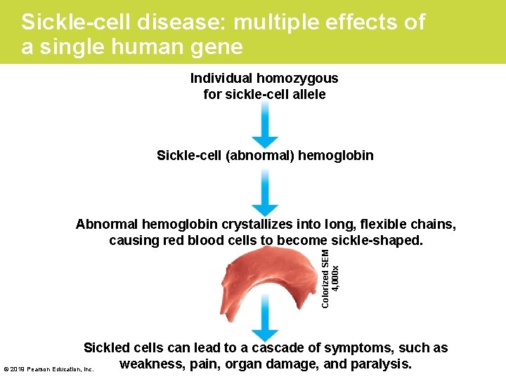 Sickle-cell disease: multiple effects of a single human gene Individual homozygous for sickle-cell allele
