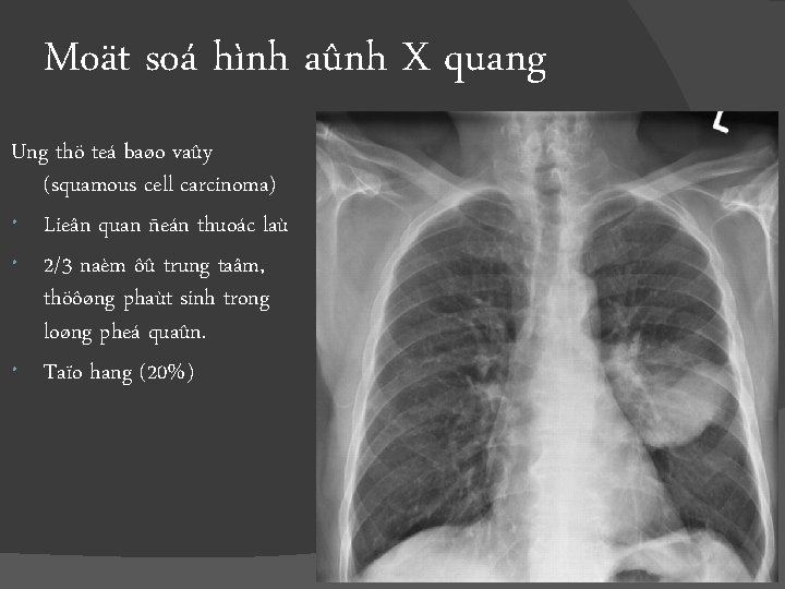 Moät soá hình aûnh X quang Ung thö teá baøo vaûy (squamous cell carcinoma)