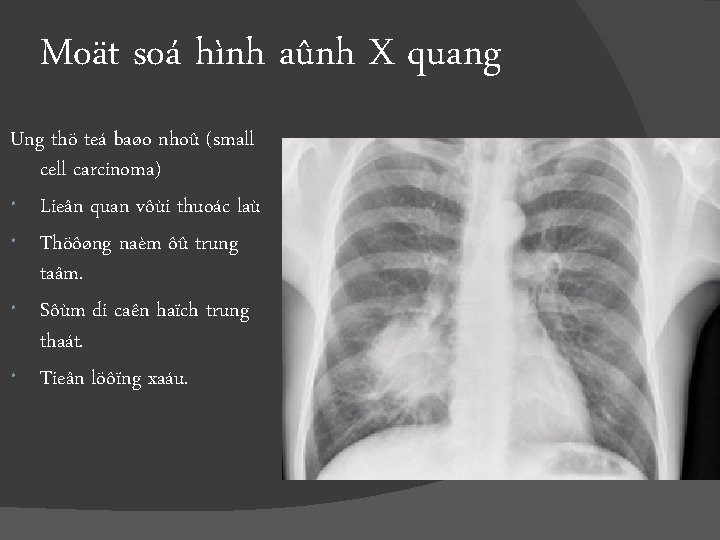 Moät soá hình aûnh X quang Ung thö teá baøo nhoû (small cell carcinoma)