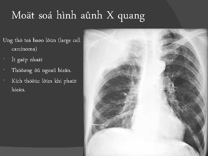 Moät soá hình aûnh X quang Ung thö teá baøo lôùn (large cell carcinoma)