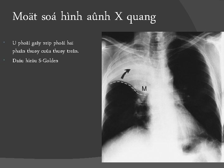 Moät soá hình aûnh X quang U phoåi gaây xeïp phoåi haï phaân thuøy