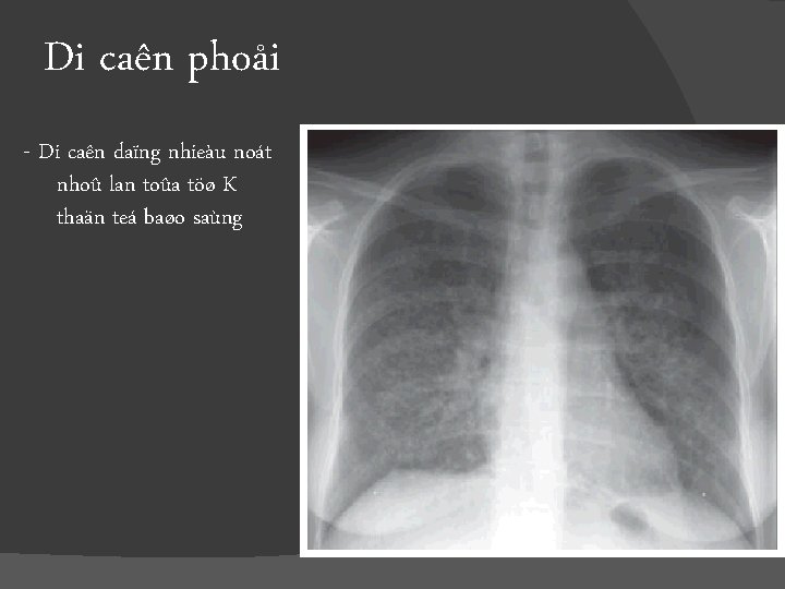 Di caên phoåi - Di caên daïng nhieàu noát nhoû lan toûa töø K