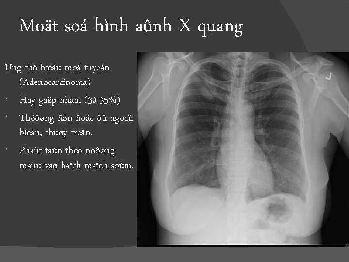 Moät soá hình aûnh X quang Ung thö bieåu moâ tuyeán (Adenocarcinoma) Hay gaëp