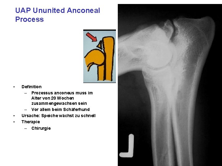 UAP Ununited Anconeal Process • • • Definition – Prozessus anconeus muss im Alter