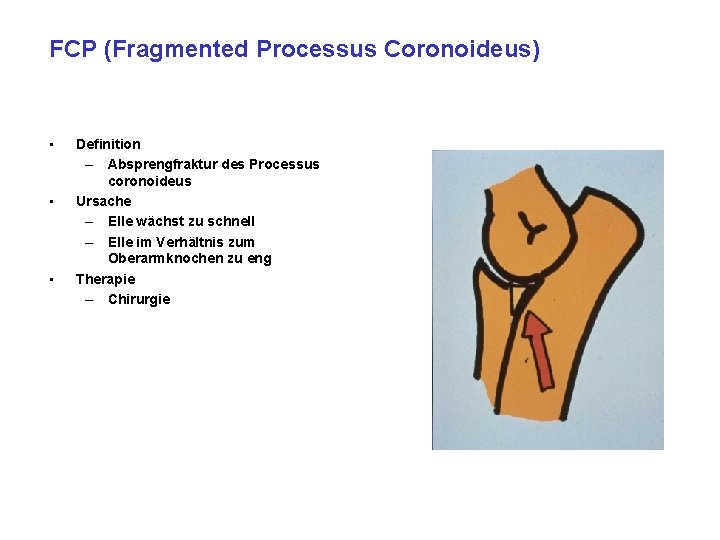 FCP (Fragmented Processus Coronoideus) • • • Definition – Absprengfraktur des Processus coronoideus Ursache