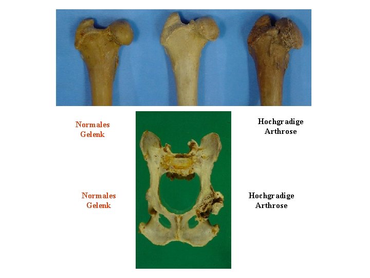 Normales Gelenk Hochgradige Arthrose 