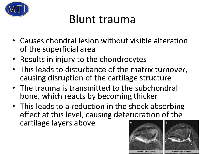 Blunt trauma • Causes chondral lesion without visible alteration of the superficial area •