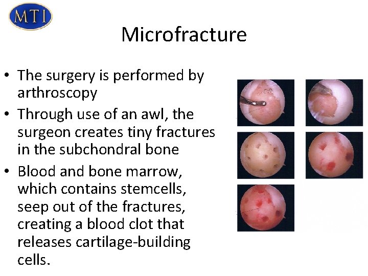 Microfracture • The surgery is performed by arthroscopy • Through use of an awl,