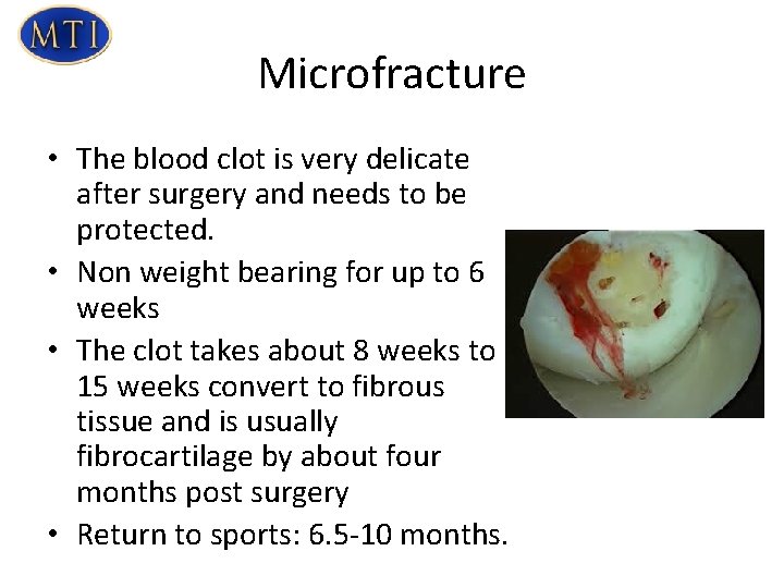 Microfracture • The blood clot is very delicate after surgery and needs to be