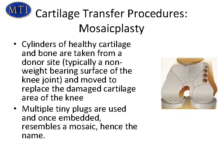 Cartilage Transfer Procedures: Mosaicplasty • Cylinders of healthy cartilage and bone are taken from