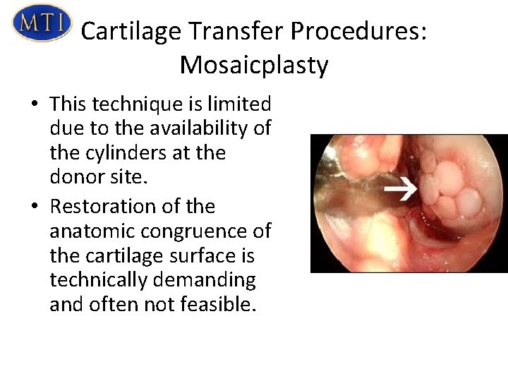 Cartilage Transfer Procedures: Mosaicplasty • This technique is limited due to the availability of
