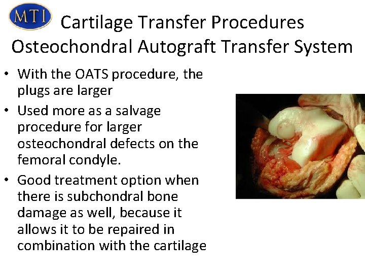 Cartilage Transfer Procedures Osteochondral Autograft Transfer System • With the OATS procedure, the plugs