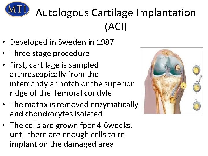 Autologous Cartilage Implantation (ACI) • Developed in Sweden in 1987 • Three stage procedure