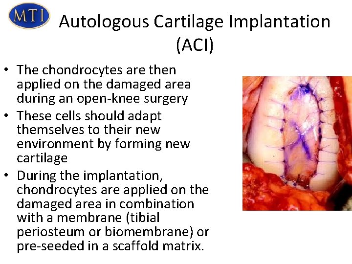 Autologous Cartilage Implantation (ACI) • The chondrocytes are then applied on the damaged area