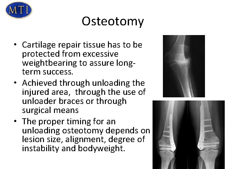 Osteotomy • Cartilage repair tissue has to be protected from excessive weightbearing to assure