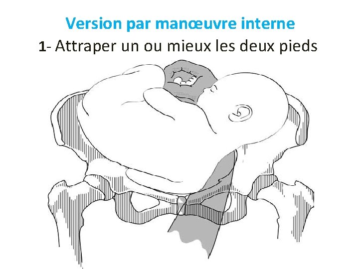 Version par manœuvre interne 1 - Attraper un ou mieux les deux pieds 