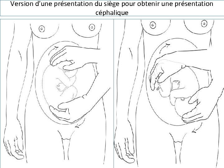 Version d'une présentation du siège pour obtenir une présentation céphalique 