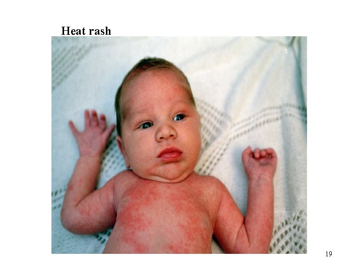 Heat rash 19 