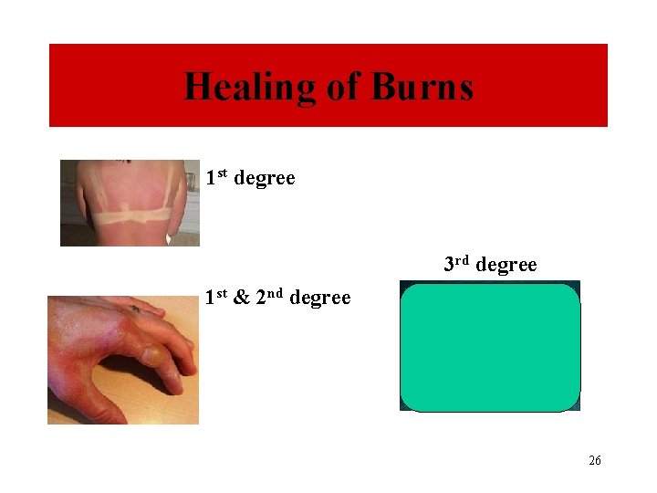 Healing of Burns 1 st degree 3 rd degree 1 st & 2 nd