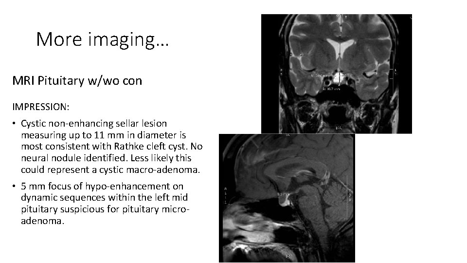 More imaging… MRI Pituitary w/wo con IMPRESSION: • Cystic non-enhancing sellar lesion measuring up