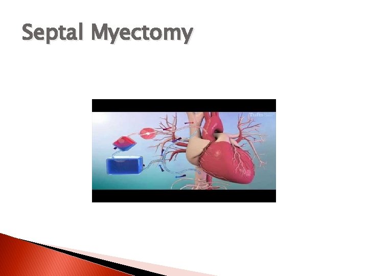 Septal Myectomy 