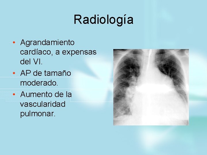 Radiología • Agrandamiento cardíaco, a expensas del VI. • AP de tamaño moderado. •