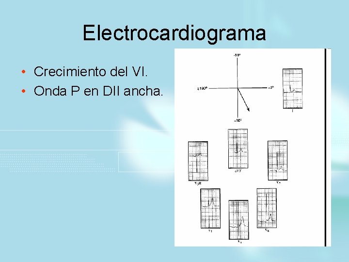 Electrocardiograma • Crecimiento del VI. • Onda P en DII ancha. 