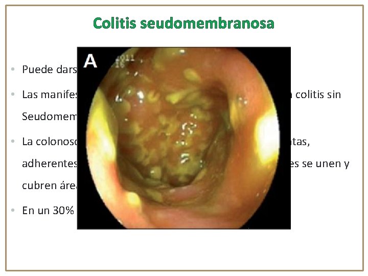 Colitis seudomembranosa • Puede darse 41% de los casos de DACD • Las manifestaciones