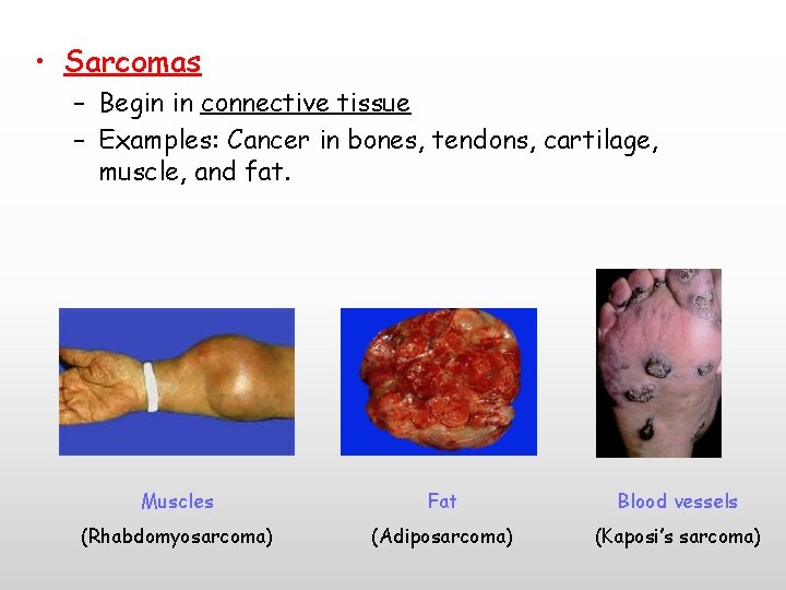  • Sarcomas – Begin in connective tissue – Examples: Cancer in bones, tendons,