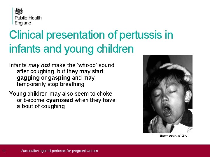 Clinical presentation of pertussis in infants and young children Infants may not make the