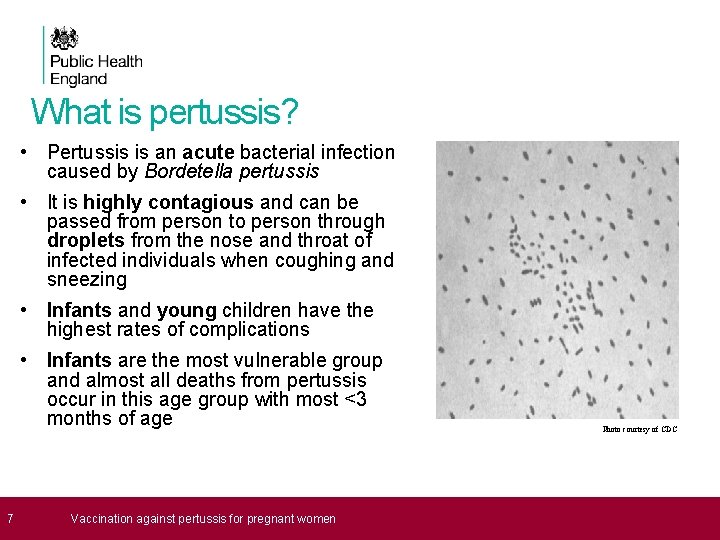 What is pertussis? • Pertussis is an acute bacterial infection caused by Bordetella pertussis