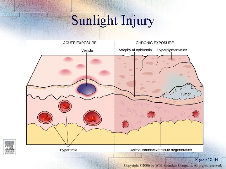 Sunlight Injury Figure 18 -04 