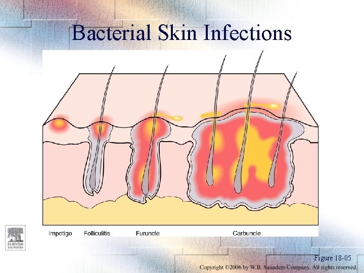 Bacterial Skin Infections Figure 18 -05 
