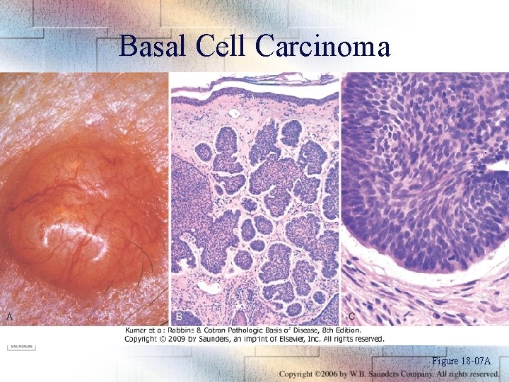 Basal Cell Carcinoma Figure 18 -07 A 