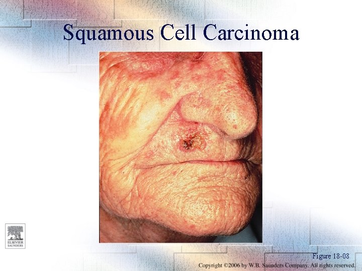 Squamous Cell Carcinoma Figure 18 -08 