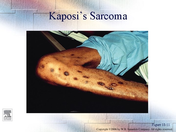 Kaposi’s Sarcoma Figure 18 -11 