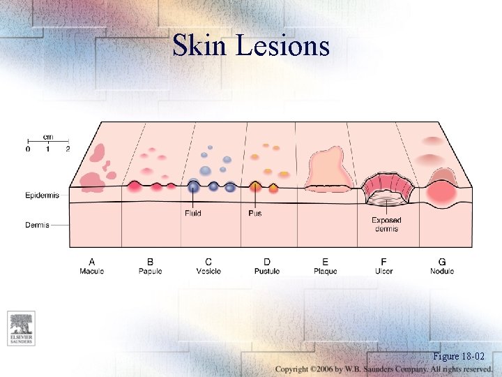 Skin Lesions Figure 18 -02 