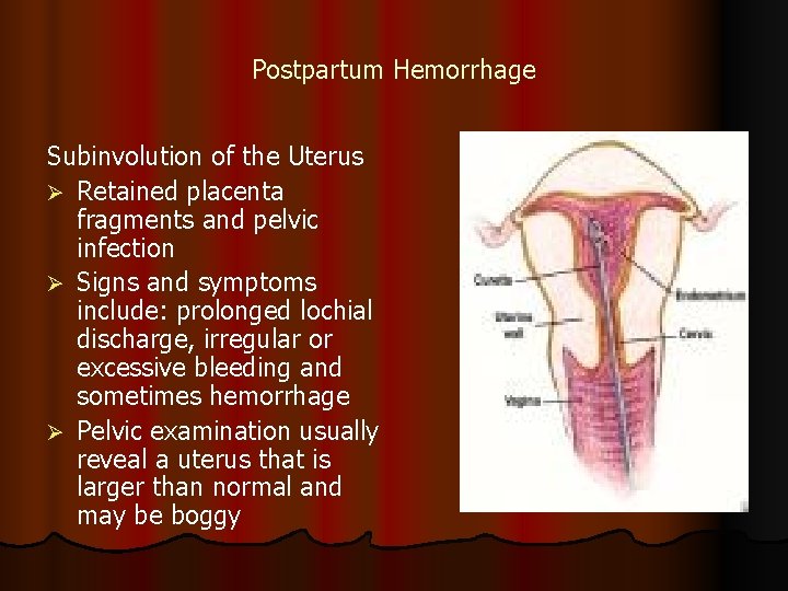 Postpartum Hemorrhage Subinvolution of the Uterus Ø Retained placenta fragments and pelvic infection Ø