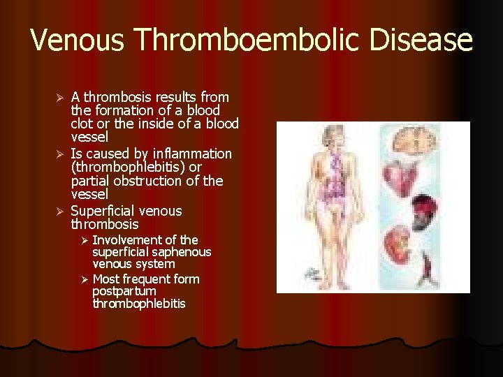 Venous Thromboembolic Disease A thrombosis results from the formation of a blood clot or Venous Thromboembolic Disease A thrombosis results from the formation of a blood clot or