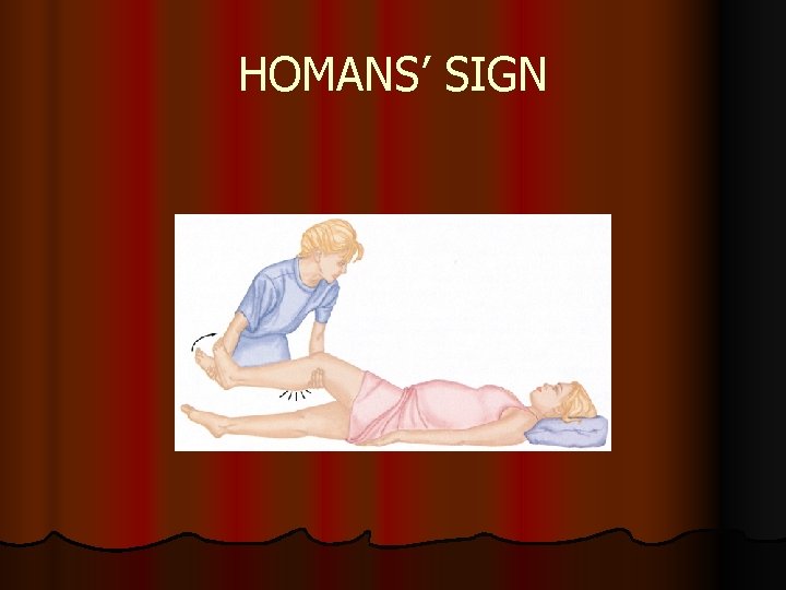 HOMANS’ SIGN HOMANS’ SIGN