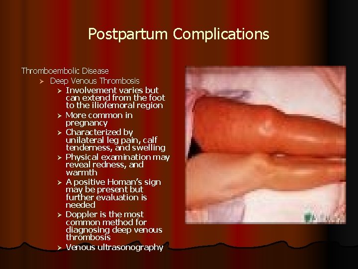 Postpartum Complications Thromboembolic Disease Ø Deep Venous Thrombosis Ø Involvement varies but can extend Postpartum Complications Thromboembolic Disease Ø Deep Venous Thrombosis Ø Involvement varies but can extend