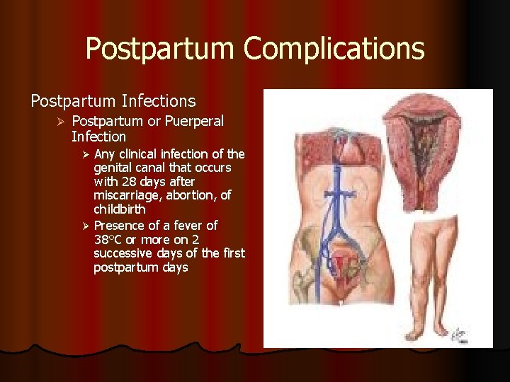 Postpartum Complications Postpartum Infections Ø Postpartum or Puerperal Infection Any clinical infection of the