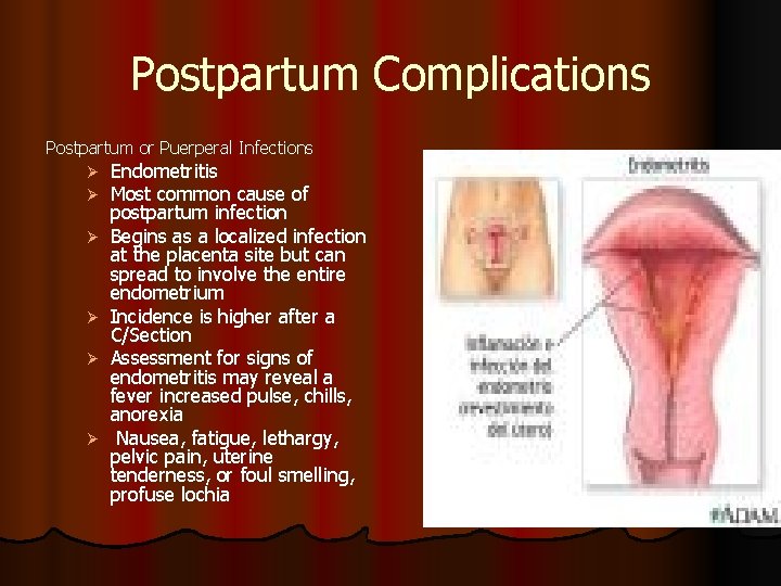 Postpartum Complications Postpartum or Puerperal Infections Ø Ø Ø Endometritis Most common cause of