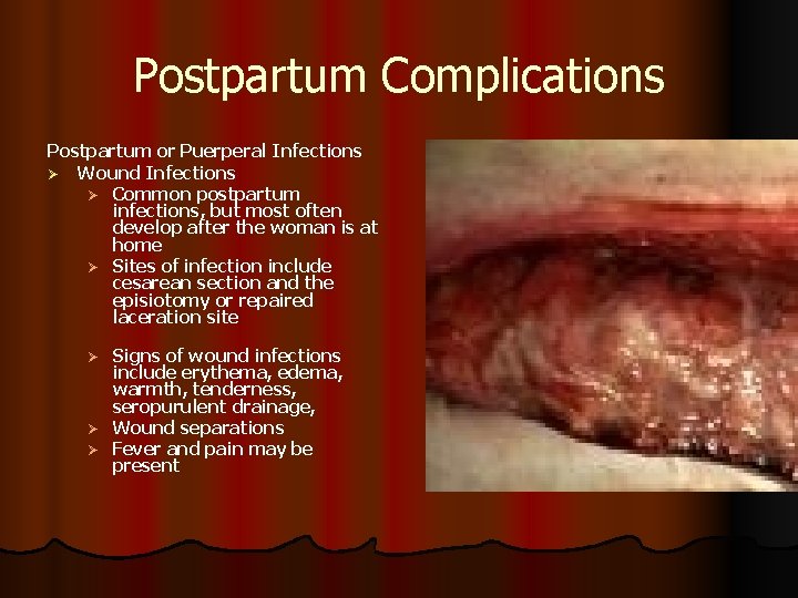 Postpartum Complications Postpartum or Puerperal Infections Ø Wound Infections Ø Common postpartum infections, but