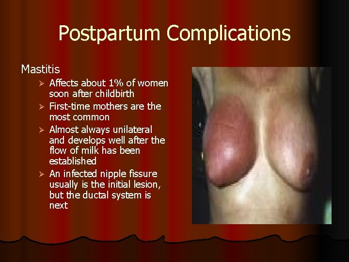 Postpartum Complications Mastitis Affects about 1% of women soon after childbirth Ø First-time mothers Postpartum Complications Mastitis Affects about 1% of women soon after childbirth Ø First-time mothers