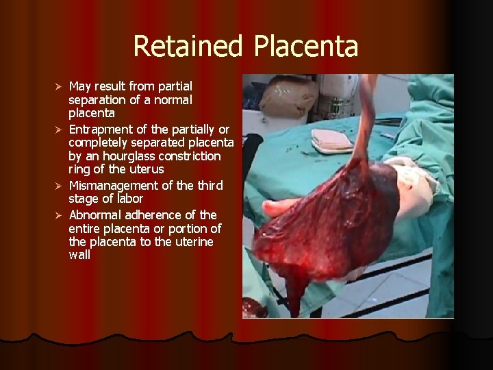 Retained Placenta May result from partial separation of a normal placenta Ø Entrapment of