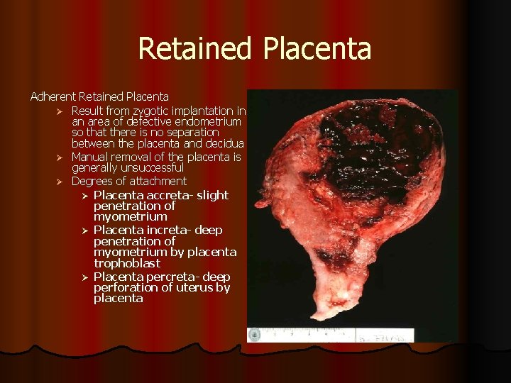 Retained Placenta Adherent Retained Placenta Ø Result from zygotic implantation in an area of