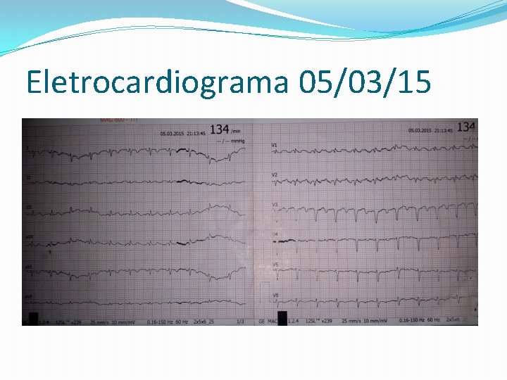 Eletrocardiograma 05/03/15 